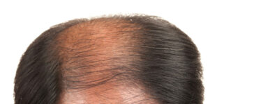 tricopigmentazione effetto densità