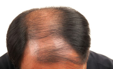 tricopigmentazione effetto densità