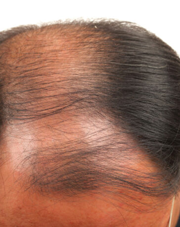 tricopigmentazione effetto densità