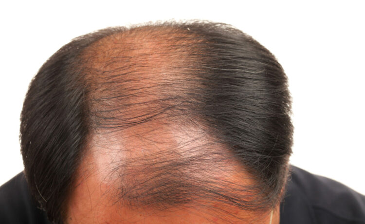 tricopigmentazione effetto densità